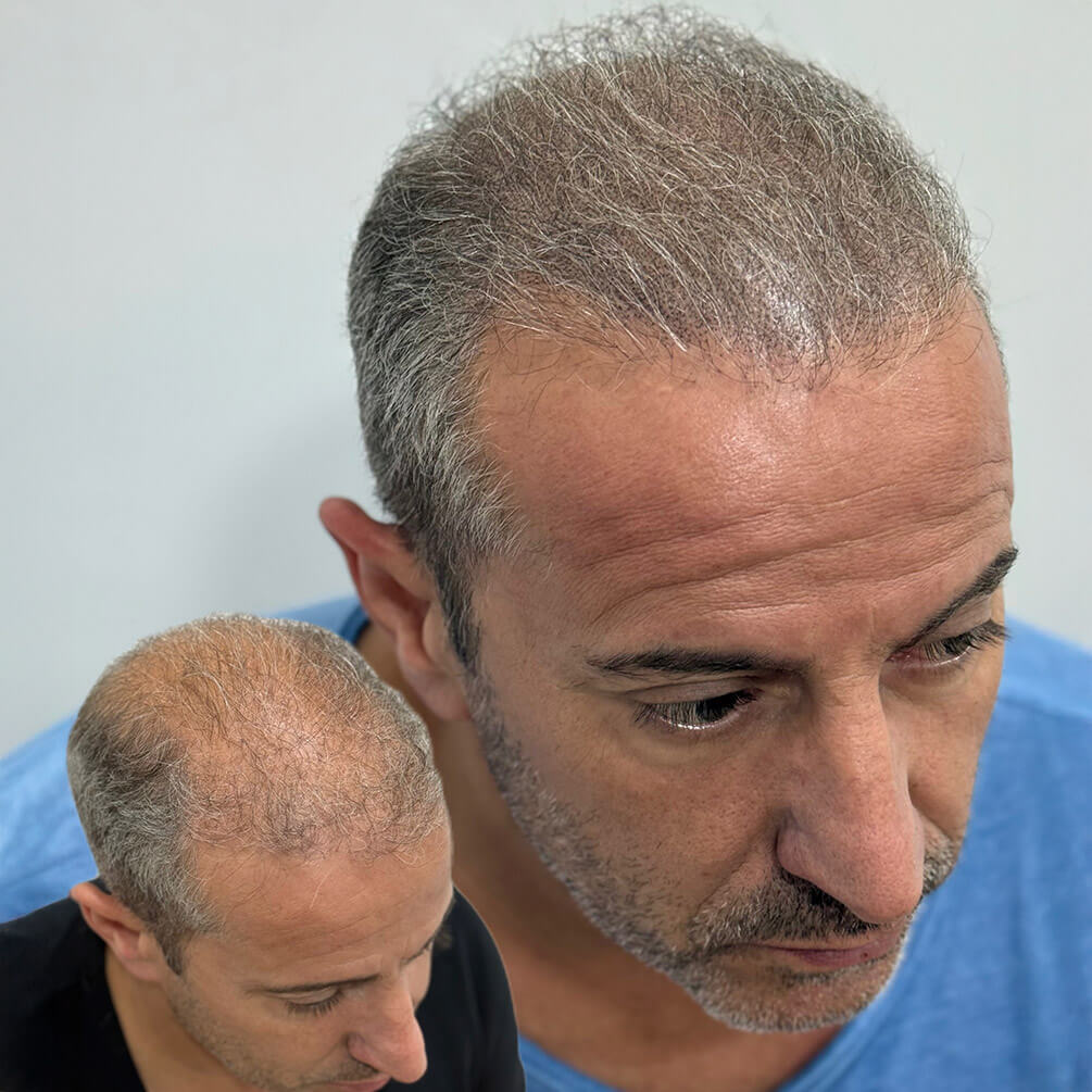 14depoimentos-micropigmentação-André