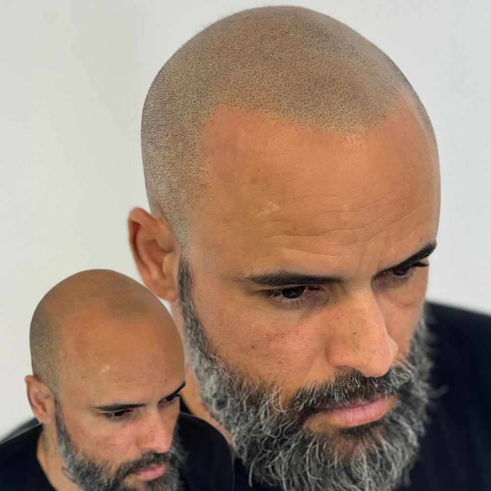 15depoimentos-micropigmentação-André
