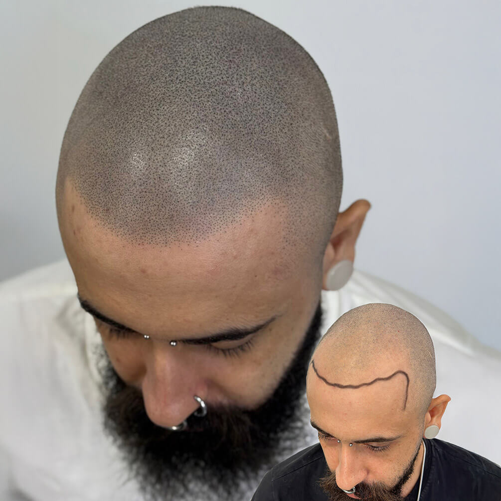 16depoimentos-micropigmentação-André