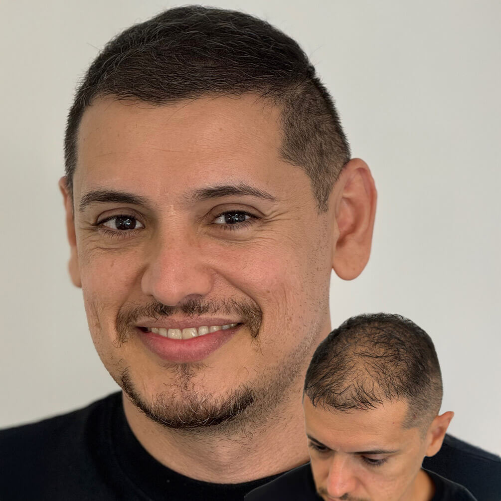 18depoimentos-micropigmentação-André