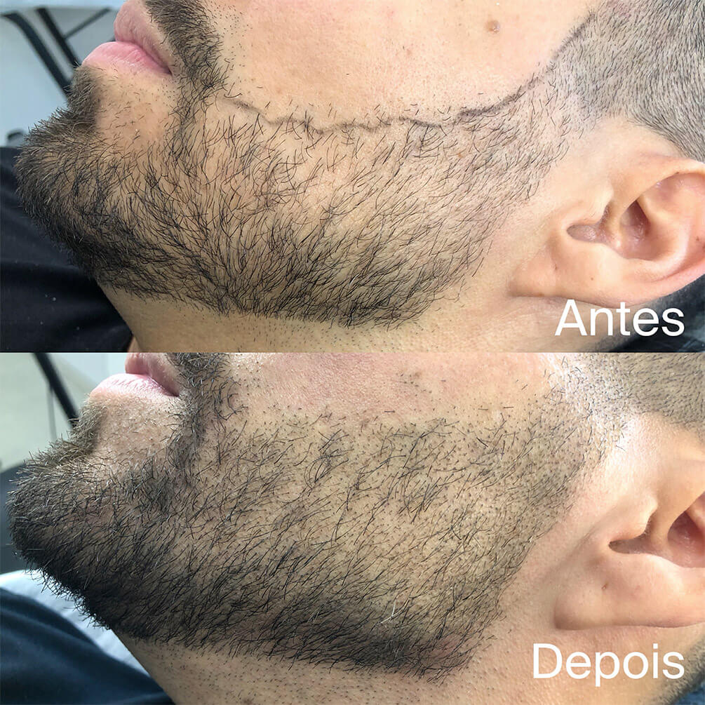 2depoimentos-micropigmentação-André